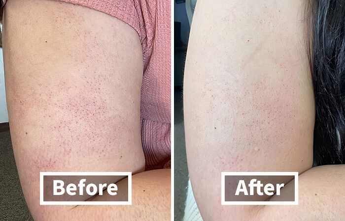 If Your Arms Are Feeling Bumpier That The Surface Of The Moon, Try This KP Removing Scrub That Users Swear By