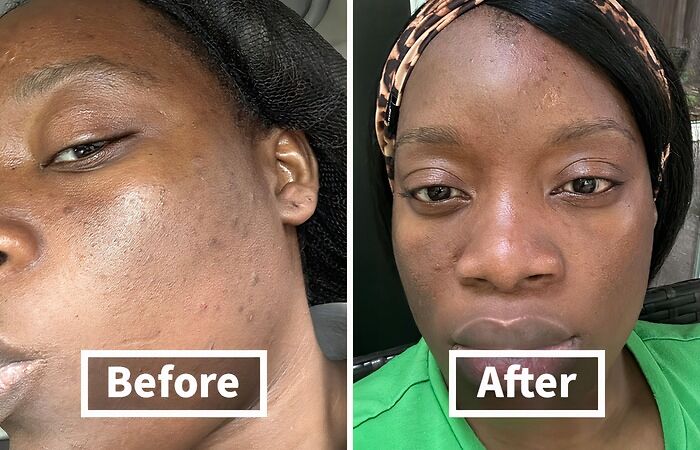 Every Girl's Dream Is To Find A Dark Spot Remover That Actually Works. Look No Further! 