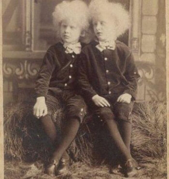 The Hadley Albino Twins, Charlie And Danny, Aged 9, Featured On A Cabinet Card Circa 1880s - 1890s