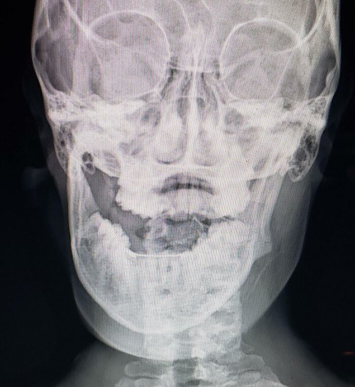 A Fear Of Eating Too Hard