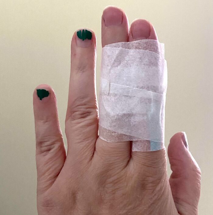 Fingertips Stomped By A 3-Year-Old