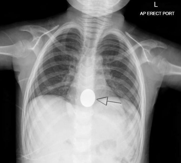 Child chest X-ray showing a coin lodged in the esophagus, illustrating parents having a pretty miserable day.