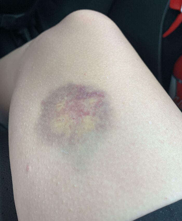 Got Bit By A 3-Year-Old