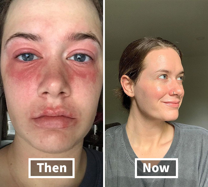 Side-by-side "Then" and "Now" comparison of improved skin, illustrating affordable skincare results.