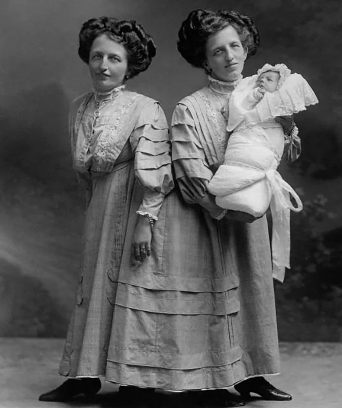 Conjoined Twins Rosa And Josepha Blažek With Rosa's Son, Franz [1910]