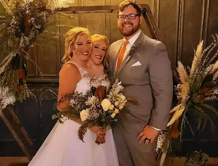 &ldquo;Feels Like Someone Messing With Your Body&rdquo;: Conjoined Twin Shares Intimate Lifestyle Details