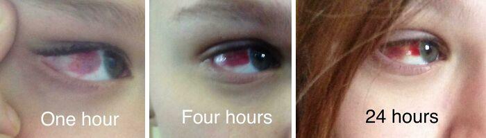 Accidentally Running Into Someone Holding An Open Cardboard Box And Cutting/Bruising Your Eye On The Flap