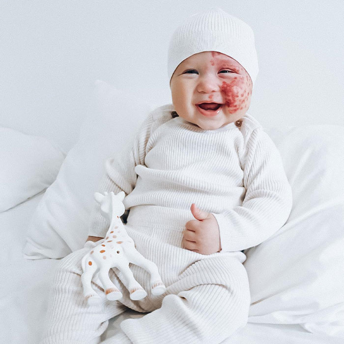 Trolls Called This Mom A &ldquo;Monster&rdquo; For Lasering Off Son&rsquo;s Birthmark&mdash;Now She&rsquo;s Making A Difference