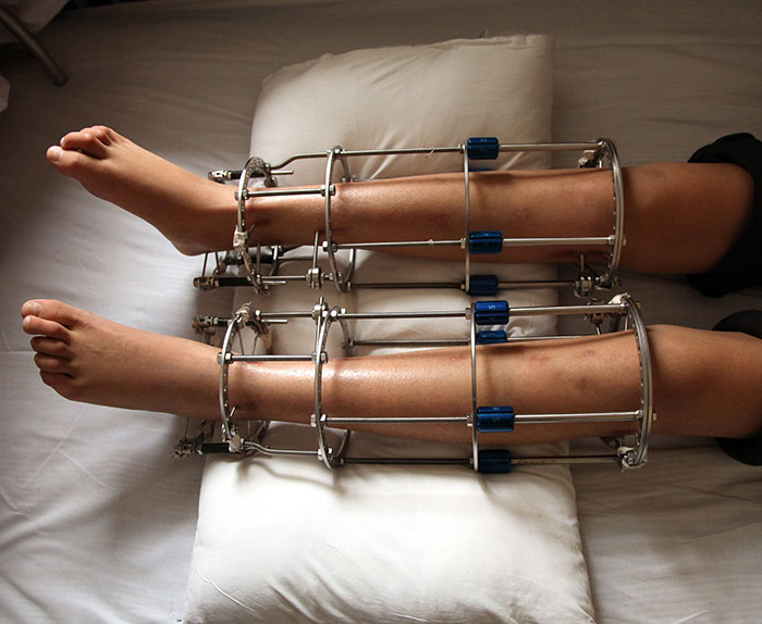 Model Who Spent $160k To Lengthen Her Legs By 5.5 Inches Left With Regrets And Career Problems