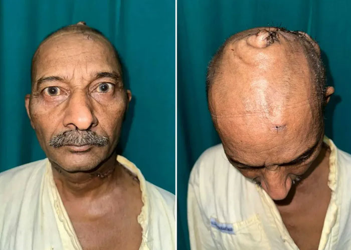 Surgeons Finally Remove 15-Lb Tumor From Man&rsquo;s Scalp After 25 Years