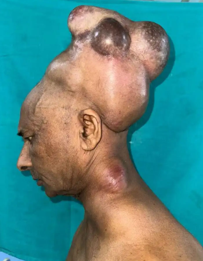 Surgeons Finally Remove 15-Lb Tumor From Man&rsquo;s Scalp After 25 Years