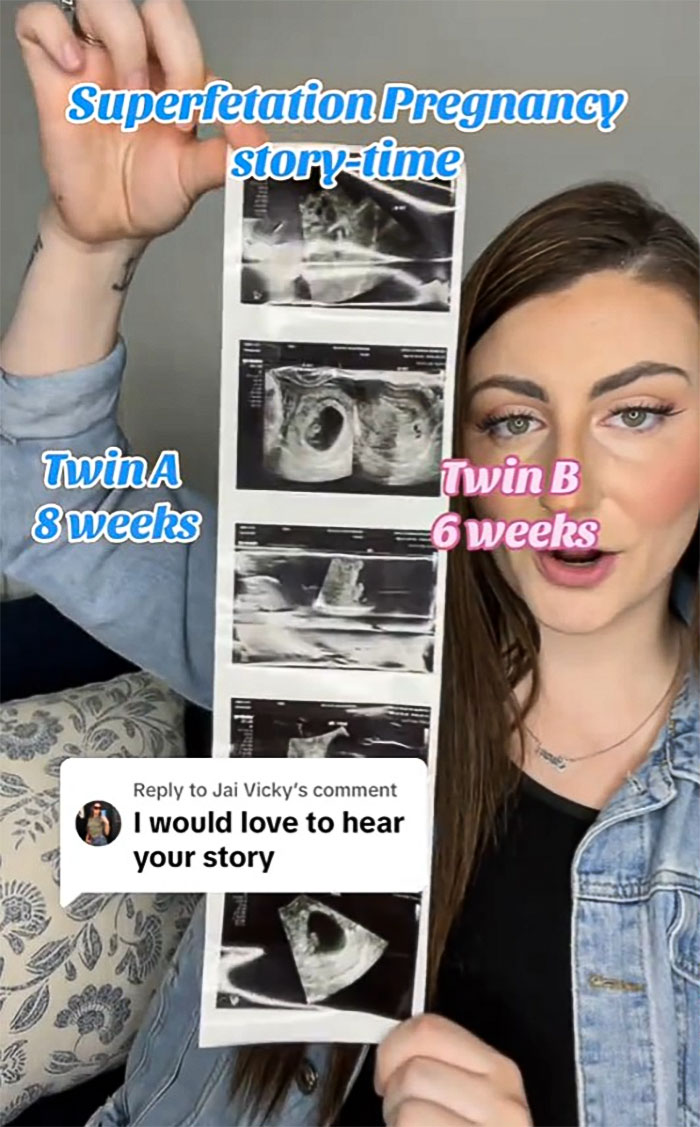 Health Professionals Stunned By Mother's "Superfetation" Pregnancy Health Professionals Stunned By Mother's "Superfetation" Pregnancy