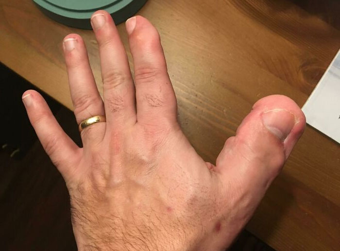 I Won The Mutational Toe-Thumb Lottery (Localized Gigantism)