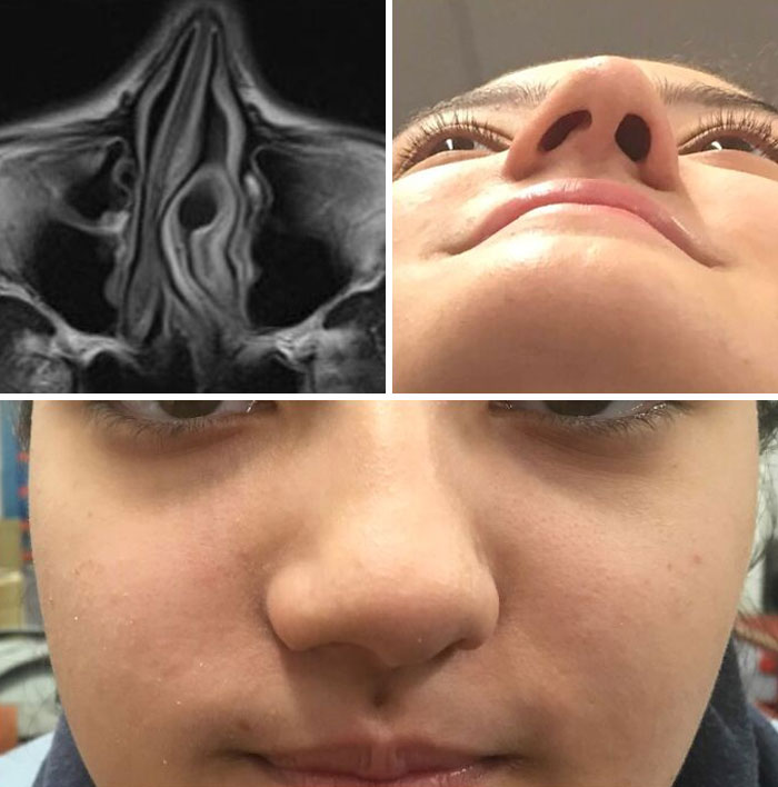 I Have A Deviated Septum And Have Had One Since Birth. It's Made Portrait-Studies And Mask-Wearing Very Fun