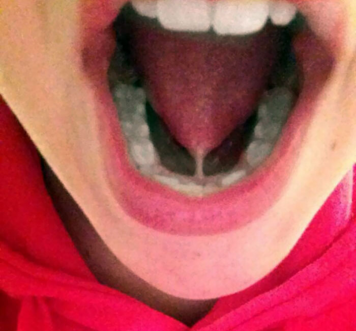 A Girl I Knew Online Years Ago Was Born With Her Tongue Slightly Connected To Her Mouth