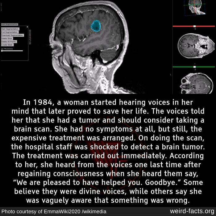 Brain scan image with text describing a weird fact about a woman hearing voices that led to a tumor discovery.