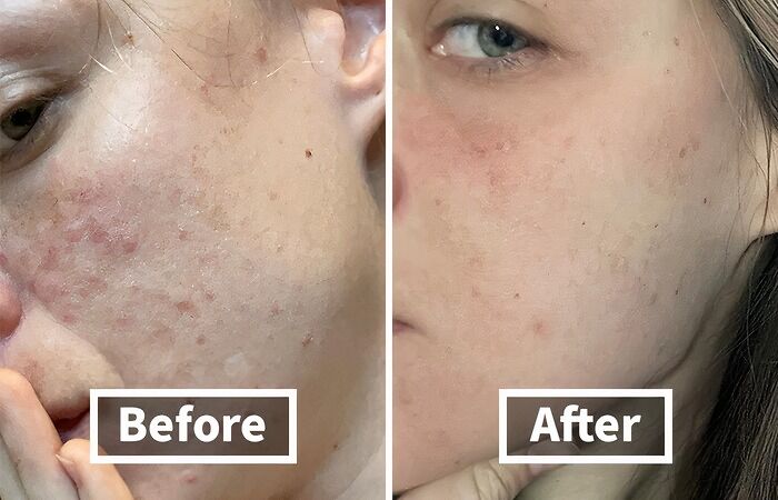 You Will Clearly Be Able To Spot The Difference After Using This Anti-Acne Soap