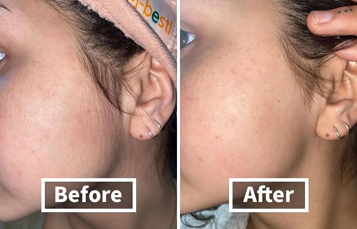 Before and after skin transformation showcasing smooth complexion improvement this year.