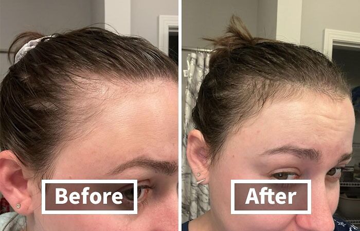 Before and after showing hair restoration results, highlighting dramatic transformations.