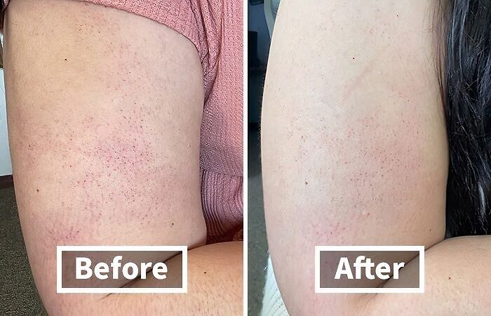 Before and after comparison of skin on arm showing improvement, illustrating effective adulting finds for personal care.