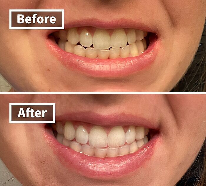 "Before and after dental transformation showcasing improved teeth alignment and whitening results."