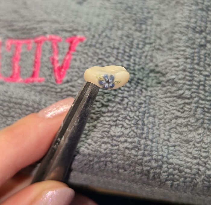 I'm A Dental Technician And My Coworker Is Getting A New Crown. She Allowed Me To Add Some Extra Love