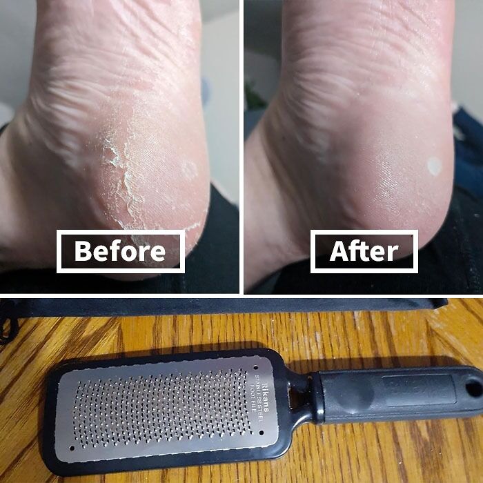 Before and after foot care transformation with file; dramatic skin improvement shown in image.