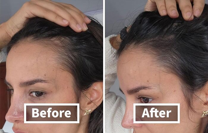 Before and after hair growth transformation, showcasing remarkable results in hairline improvement.