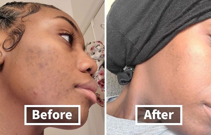 Before and after of skin transformation, showing clear improvement and demanding more in 2025.