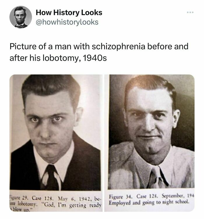 Did They Use This As #propaganda To Support Lobotomy? #viralphoto #didyouknowfacts #interestingfacts #viral #interesting #historynerd