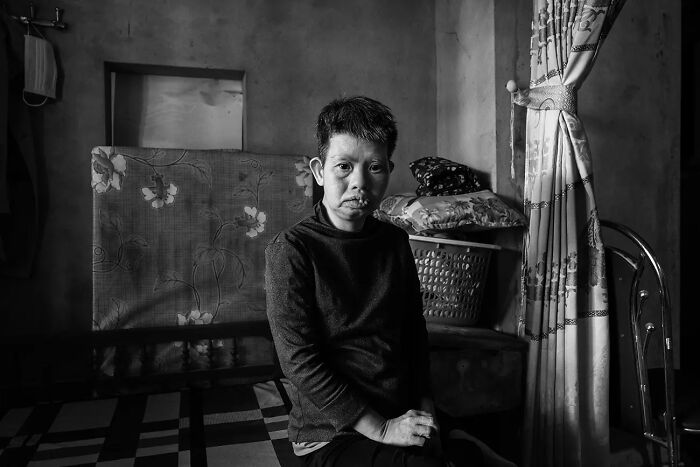 District Of Vinh Linh, Vietnam: Phūng Thê Que, 31 Years Old, She Is A Patient With Down Syndrome, A Victim Of Agent Orange Pollution. Her Father, Phūng Thê Tram Fought For North Vietnam