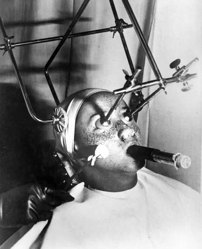 Vintage Freckle Removal