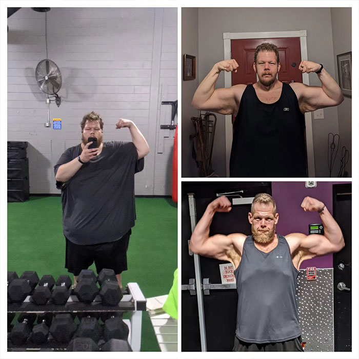 Man Raises $76k To Surgically Remove Excess Skin After Huge Weight-Loss Transformation