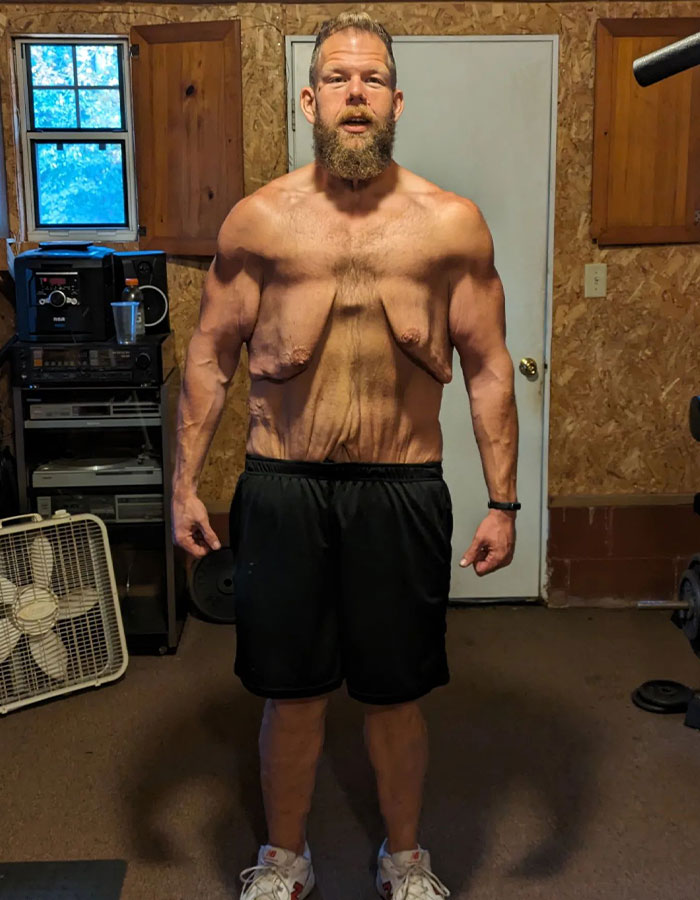 Man Raises $76k To Surgically Remove Excess Skin After Huge Weight-Loss Transformation