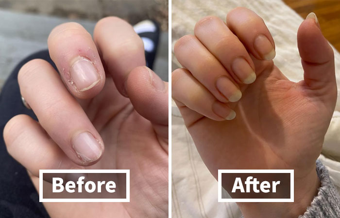 Before and after nail transformation showcasing improved nail health and growth.