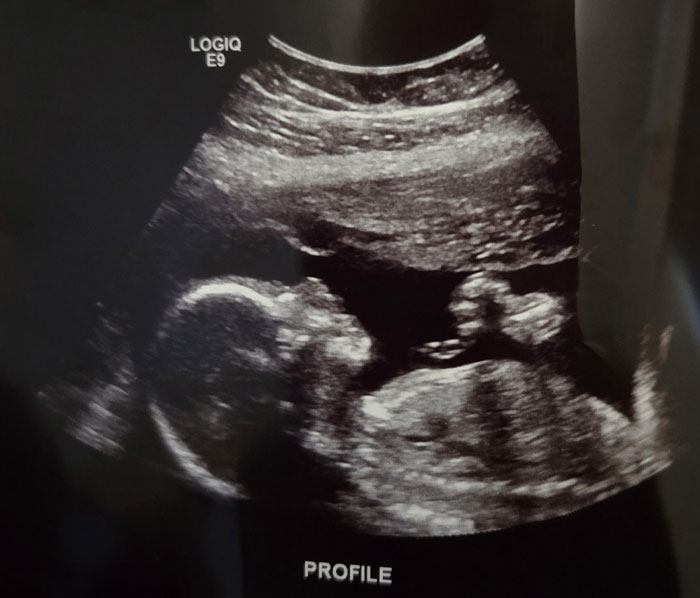 Had My Anatomy Scan Today And Got To See My Baby