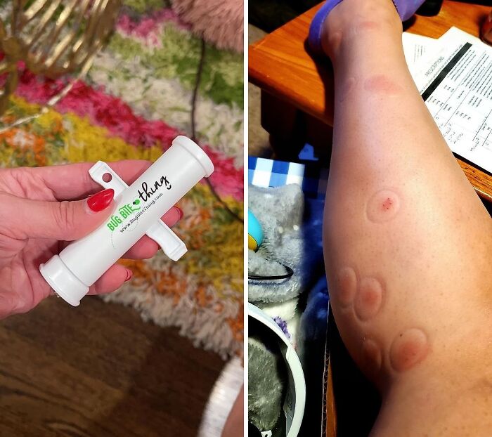 Bug bite suction tool held in hand beside a leg with multiple suction marks.