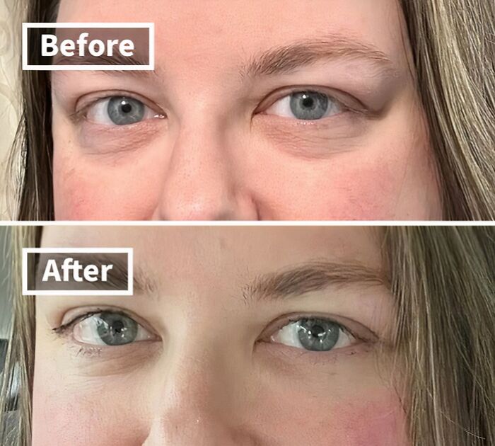 Close-up before and after images showing reduction of under-eye bags and smoother skin from TikTok Shop finds.