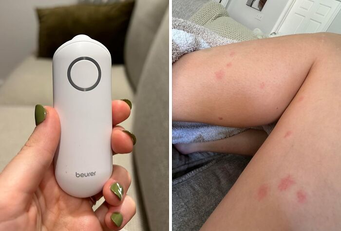  Bug Bite Thing Suction Tool: Don't Scratch That Itch, Just Suck It Up!