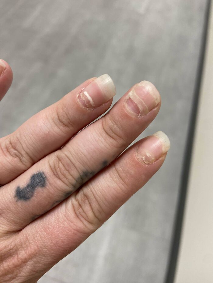 Close-up of a hand with damaged fingernails, showcasing an intriguing medical case of nail health.