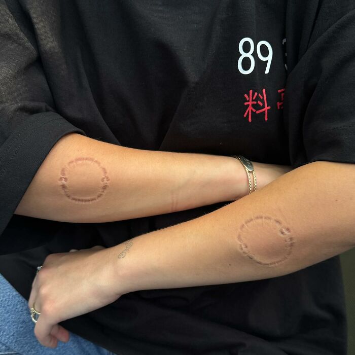 &ldquo;I&rsquo;m Drooling&rdquo;: Billie Eilish Reveals Mystery Bite Marks Along With Rare Bikini Post