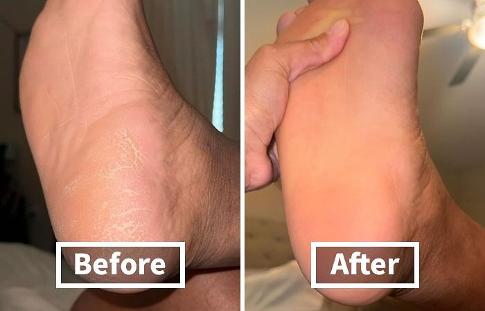 Soften And Remove Stubborn Calluses Effortlessly With A Callus Remover Gel. These Powerful Gels Work By Breaking Down The Dead Skin Cells That Form Calluses, Allowing You To Easily Buff Them Away