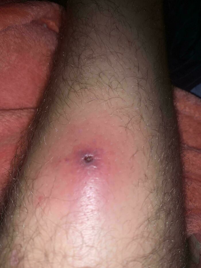 The Area Around My Tick Bite Has Lost All Its Hair