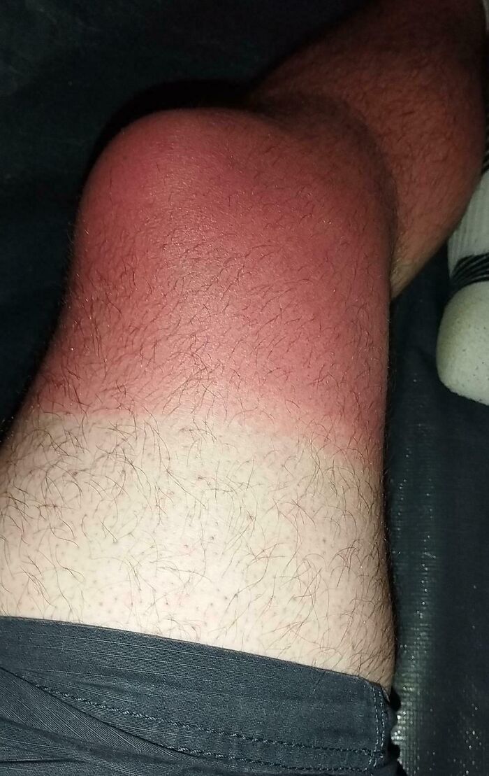Thought I'd Share My Recent Burn