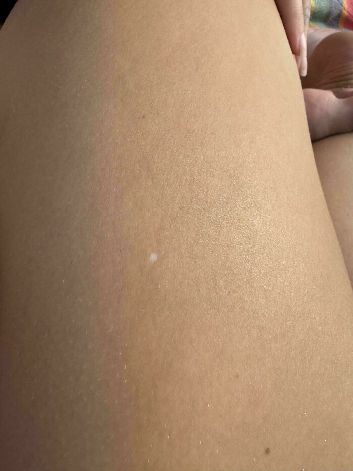 My GF Has A White Freckle