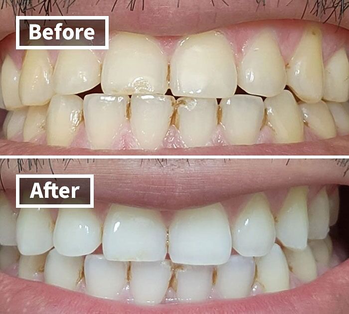 Pandas Are Saying Goodbye To Yellow Teeth And Hello To A Brighter Smile With This Top-Rated Whitestrips Kit