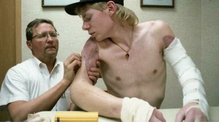 In 1992, John Thompson Was Home Alone When He Had Both His Arms Ripped Off In A Farming Accident. However He Still Managed To Get Up And Dial For Help By Holding A Pencil In His Mouth. He Survived And Both His Arms Were Reattached