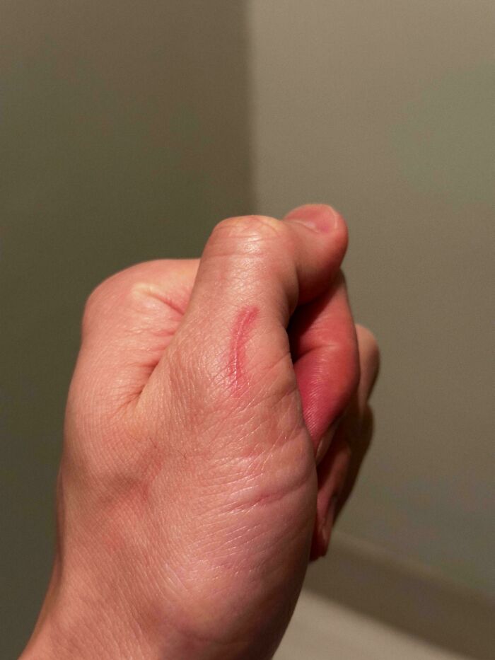 When I Drink Alcohol My Scar On My Thumb Lights Up Like A Neon Light Or Lightsaber