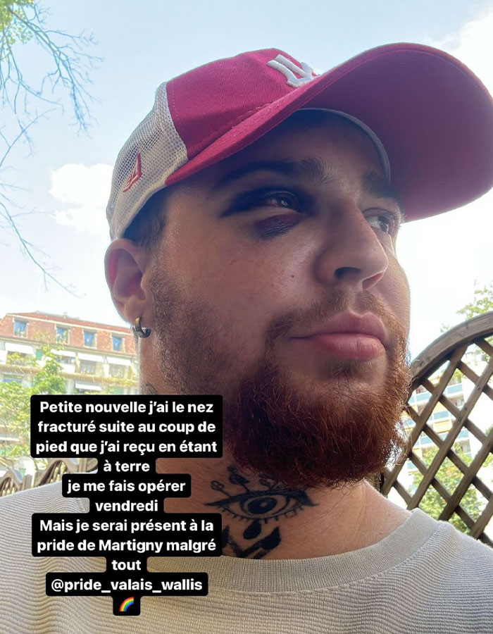 29-Year-Old Trans Man Gets Brutally Beaten Up In Switzerland, Claims It&rsquo;s A Hate Crime