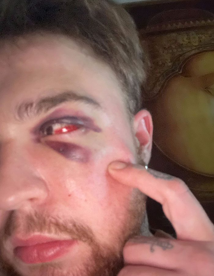 29-Year-Old Trans Man Gets Brutally Beaten Up In Switzerland, Claims It&rsquo;s A Hate Crime